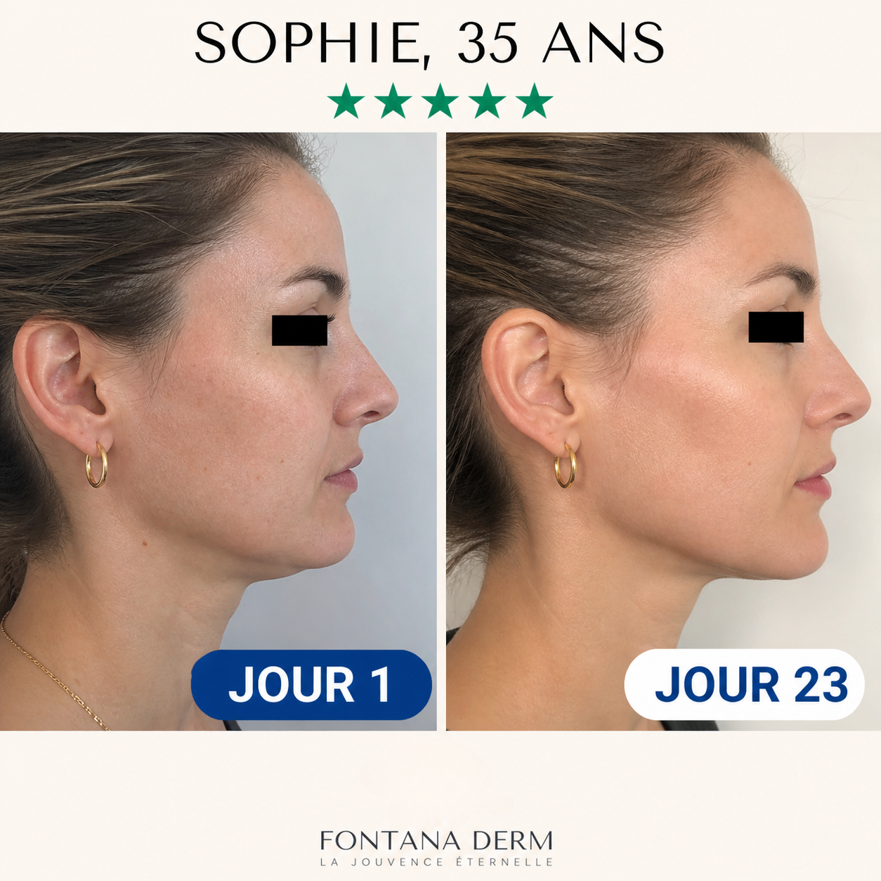 Masque Liftant Réutilisable Intensif — Fontana Derm™